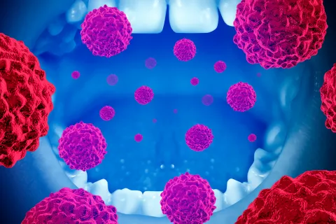 El 48% de los tumores de orofaringe podrían deberse al sexo oral Concepto de cáncer oral