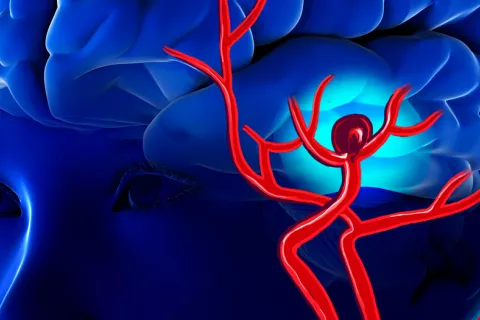 La aspirina podría prevenir las hemorragias por aneurismas Ilustración de una hemorragia por aneurisma