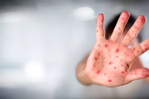 El sarampión reduce la protección inmune frente a otras infecciones Protección frente al sarampión