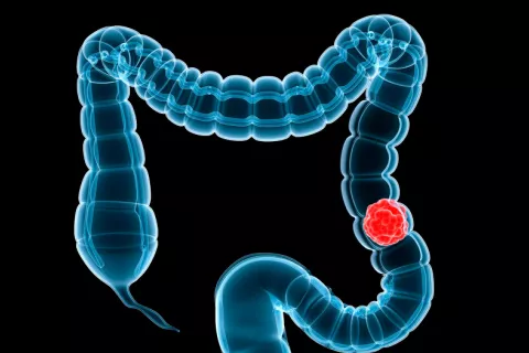 Un nuevo análisis para detectar el cáncer de colon evita colonoscopias Cáncer de colon