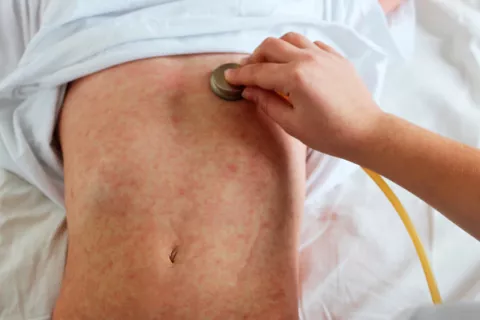 140.000 personas murieron por sarampión en 2018, la mayoría niños Nino con sarampión