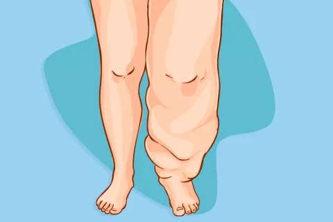 El linfedema se podría tratar con un fármaco contra el glaucoma Linfedema