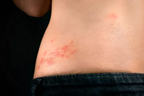 La vacuna contra el herpes zóster ayuda a reducir el riesgo de ictus herpes zóster