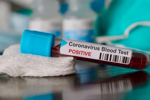 Muestra de sangre infectada con coronavirus Prueba coronavirus positiva