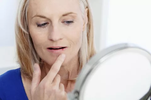 El virus del herpes causa signos de alzhéimer en tejido cerebral Mujer adulta con el virus del herpes en los labios