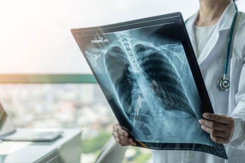 Radiografía que muestra una infección pulmonar
