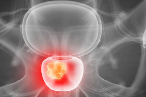 La terapia hormonal podría frenar la metástasis por cáncer de próstata