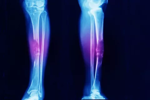 Identifican nuevos genes que predisponen a desarrollar un osteosarcoma Identifican nuevos genes que predisponen a desarrollar un cáncer óseo