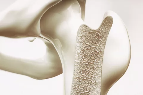 Raloxifeno, un fármaco contra osteoporosis, efectivo en COVID-19 leve Raloxifeno, un fármaco contra osteoporosis, efectivo en coronavirus leve