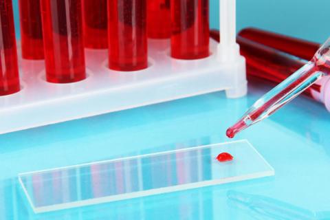 Test de sangre, hasta 10 veces más sensible para detectar cáncer
