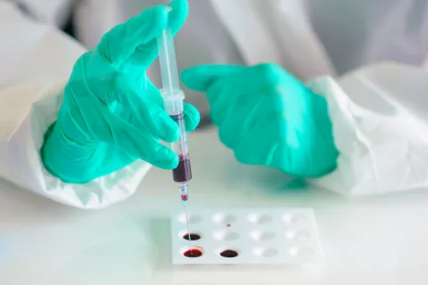 Analizar esoxomas cerebrales en la sangre ayudaría a diagnosticar ELA Analizar esoxomas cerebrales en la sangre podría diagnosticar ELA