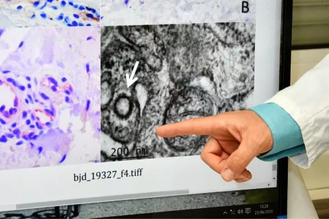 Presencia de coronavirus en una biopsia cutánea