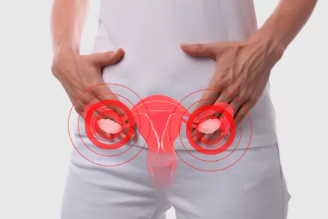 Asocian SOP y más riesgo de trastornos neuropsiquiátricos en los hijos Paciente con síndrome de ovario poliquístico (SOP)