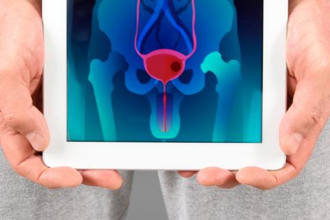 La técnica HIFU contra el cáncer de próstata