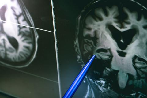 Nueva alteración en el cerebro de personas con alzhéimer