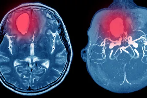 Hallan qué molécula empeora el pronóstico de la hemorragia intracraneal Pronóstico de hemorragia intracraneal