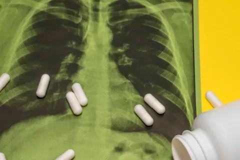 La FDA aprueba la primera terapia contra el mesotelioma en 16 años Mesotelioma: la FDA aprueba una terapia