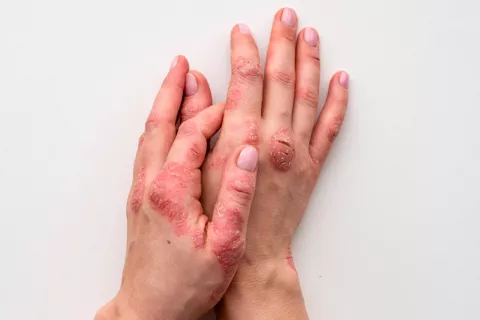 Hallan el posible origen del desarrollo de la psoriasis y el eccema Psoriasis y eccema: hallan su origen
