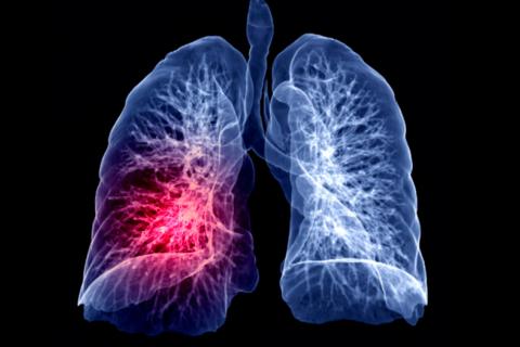 Secuelas respiratorias pos-COVID-19