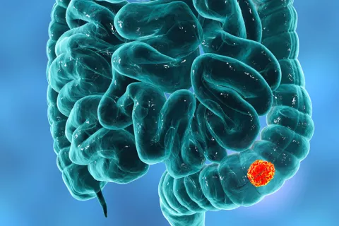 Hallan nuevas dianas terapéuticas para frenar el cáncer colorrectal Posible diana contra cáncer colorrectal