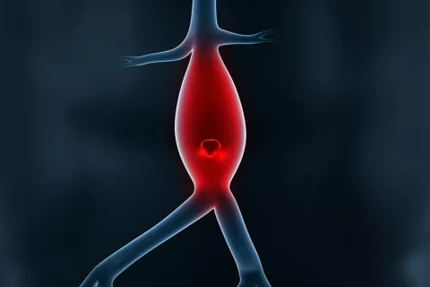 Nueva diana para frenar el avance del aneurisma aórtico abdominal Nueva técnica para frenar el avance del aneurisma aórtico abdominal