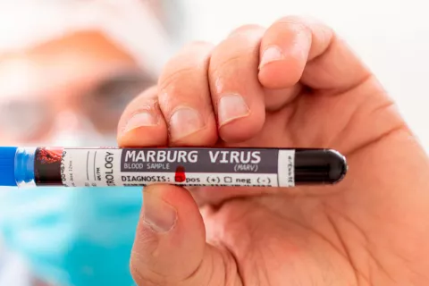 Primer caso de enfermedad por virus de Marburgo en África Occidental Virus Marburg: primer caso en Guinea