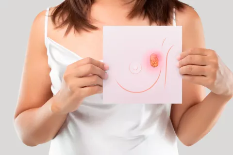 Innovadora terapia frena el 76% de casos de cáncer de mama metastásico Caballo de Troya frena cáncer de mama