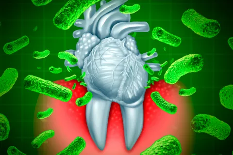Descubren cómo nos ataca la bacteria que causa la periodontitis Periodontitis, descubren cómo ataca