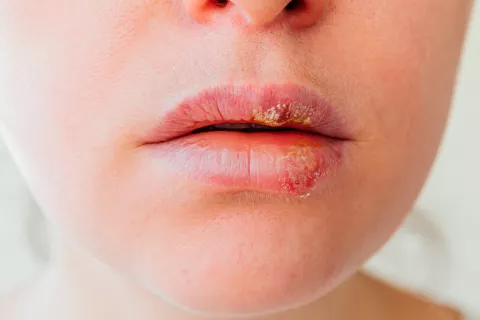 Así logra el virus herpes hibernar en el sistema inmune de por vida Herpes: desvelan su siniestro secreto