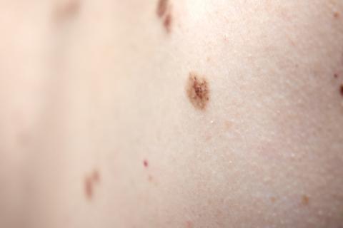 1er paso hacia vacuna para cáncer de piel