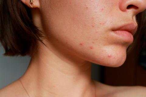 Finding 29 Acne Risk Genes Will Help Create Treatments