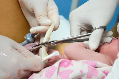 Medicos cortando el cordón umbilical entre un recién nacido y la placenta