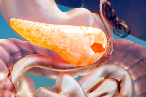 La inteligencia artificial detecta el cáncer de páncreas precozmente IA predice cáncer de páncreas años antes