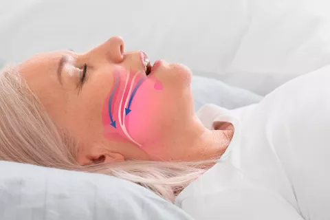 Investigadores españoles logran curar la apnea obstructiva del sueño Curan la apnea obstructiva del sueño