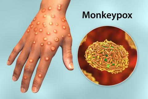 Ampollas en la mano características del contagio por viruela del mono