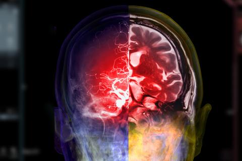 Escáner cerebral diagnostica alzhéimer