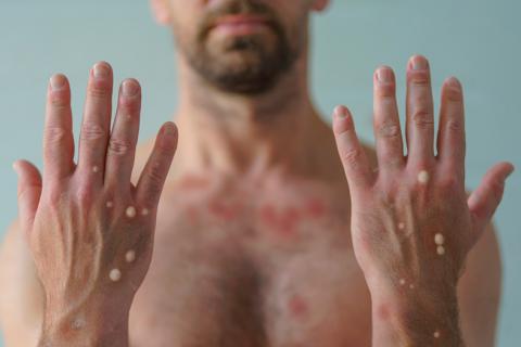 Hombre con signos de contagio por viruela del mono en las manos
