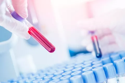Test de sangre para detectar ADN tumoral en la sangre Análisis de sangre para detectar el cáncer