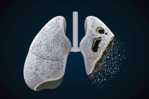 Cáncer de pulmón: avance en tratamiento