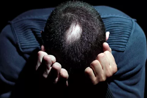 Persona con alopecia areata y síntomas de ansiedad