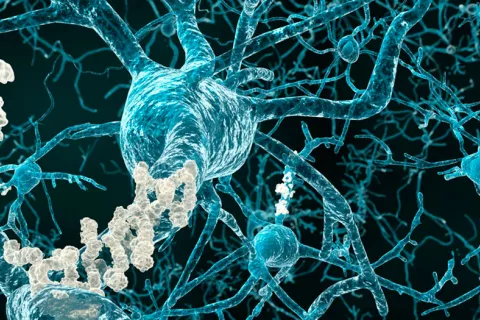 Descubren un factor inmunológico que contribuye al alzhéimer Neuronas con placas amiloides