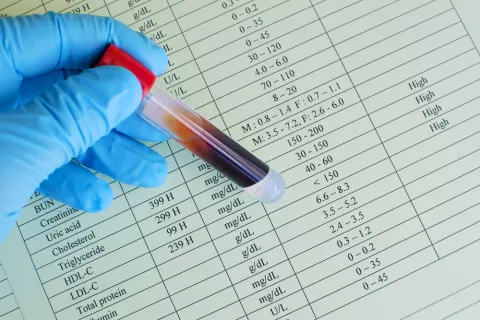 La mutación en un gen podría elevar el colesterol y la glucosa Colesterol y glucosa en sangre se pueden elevar por mutación en un gen