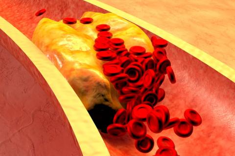 Arteria taponada por el colesterol