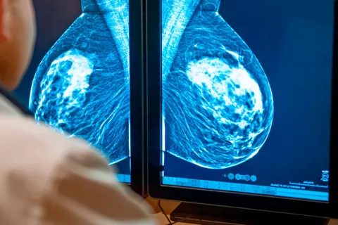 Descubren cómo frenar el desencadenante del cáncer de mama metastásico Médico analizando una mamografía