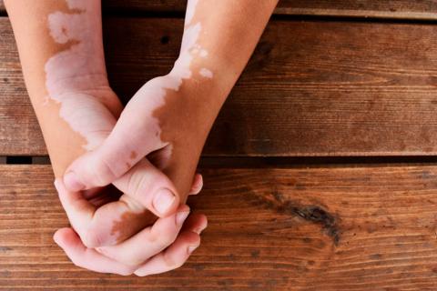 Una mujer con vitiligo en las manos