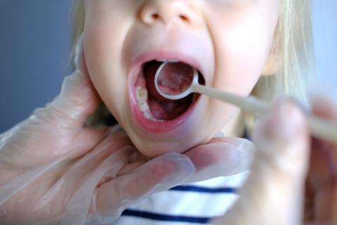 Niño con caries en la consulta del dentista 