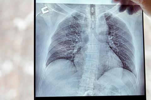 Médico sostiene una radiografía de los pulmones