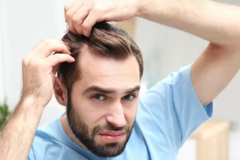 El fármaco finasterida para tratar la alopecia puede inducir ideas suicidas Hombre joven con problemas de alopecia