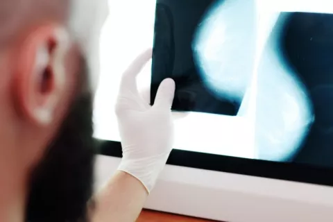 Un fármaco para tratar la osteoporosis potencia la respuesta inmune contra el cáncer de mama Médico observa imágenes de mamografía