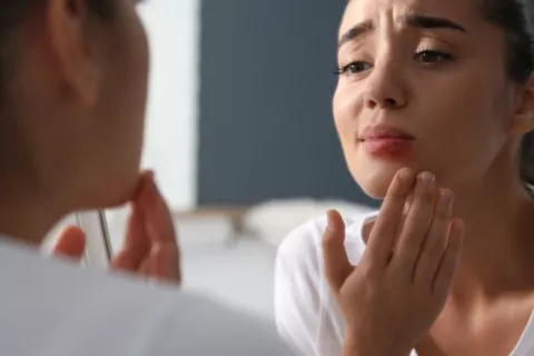 Las infecciones por herpes labial podrían aumentar el riesgo de alzhéimer Mujer joven observa preocupada en el espejo un herpes labial